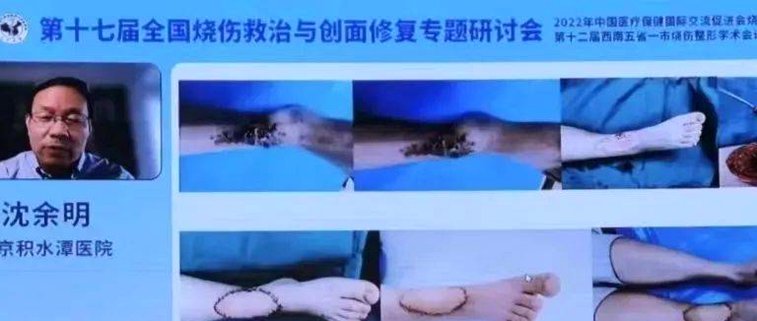 津媒：谢蒂内出现明确拉伤，恢复周期乐观估计至少也要两周