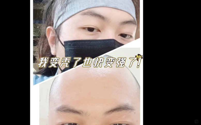 许尔策勒三个月从秀发到光头
